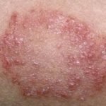 skin disease